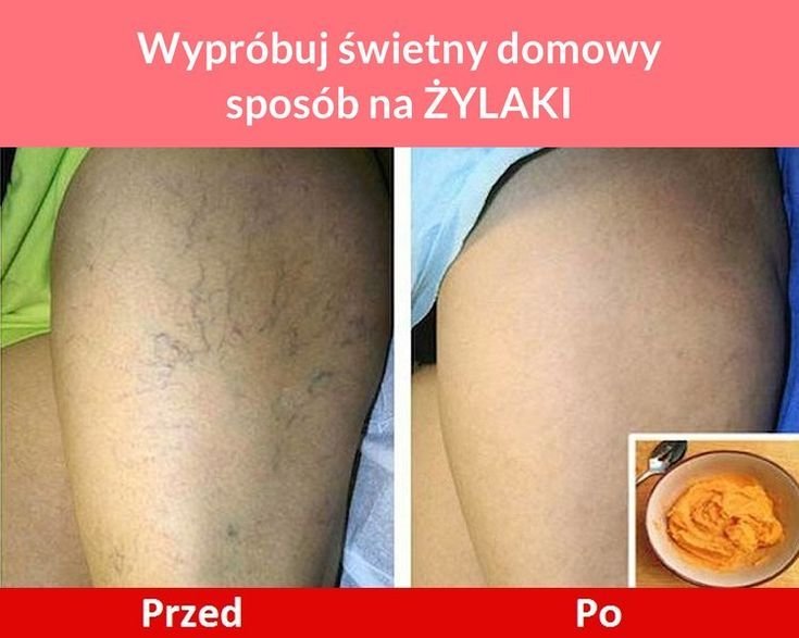 Neoveris maść na żylaki in Poland